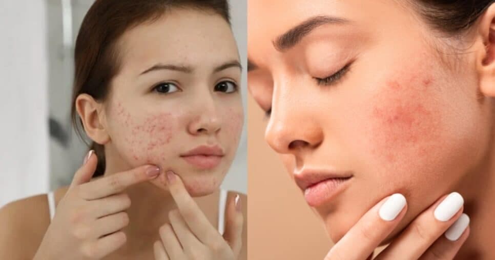 Pele radiantes e iluminada: 6 dicas infalíveis para dar fim às espinhas e manchas do rosto em casa