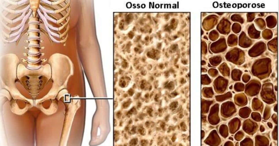 A osteoporose provoca a perda de massa óssea, tornando o osso mais frágil (Foto: Reprodução/ Internet) A osteoporose provoca a perda de massa óssea, tornando o osso mais frágil (Foto: Reprodução/ Internet)