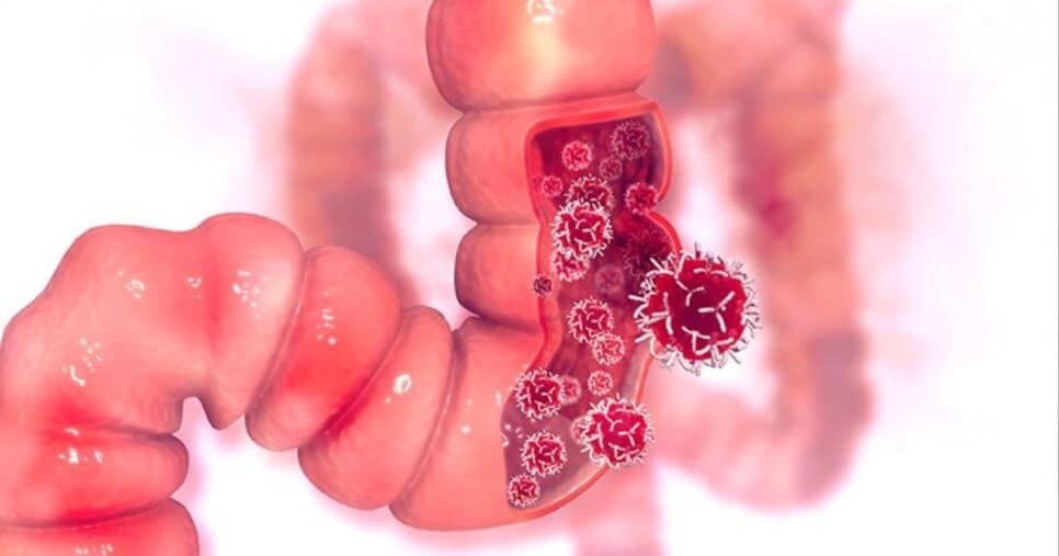 Carnes e mais: Cinco alimentos que elevam risco de câncer no intestino