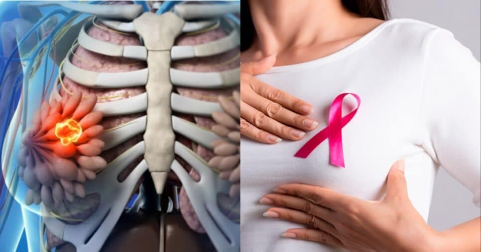 Técnica pode matar até 100% das células do câncer de mama, diz estudo