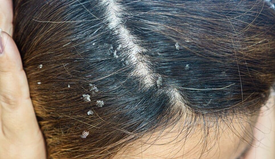 Cabelo com caspas (Foto: Divulgação) Cabelo com caspas (Foto: Divulgação)