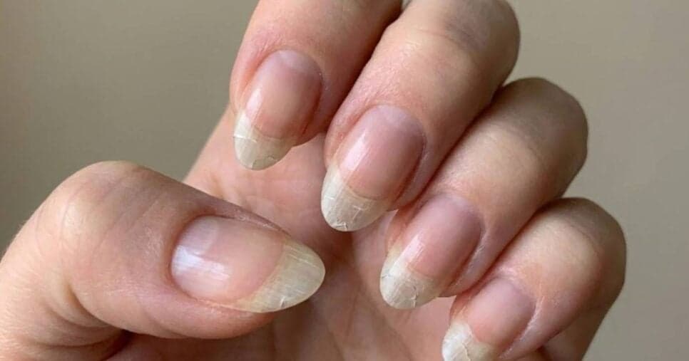 Nem manicure salva: 7 hábitos comuns que estão destruindo as unhas das mulheres